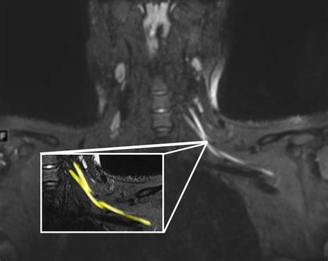 Can an MRI Show Nerve Damage in Leg: Exploring the Intersection of Technology and Imagination