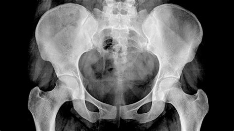 What Can an X-Ray Show for Hip Pain: A Journey Through the Bones and Beyond